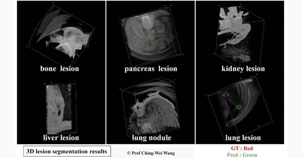 台科大研究團隊開發的「通用3D病灶分割AI模型」，可快速且精準辨識與分割多類別胸腹部病灶。