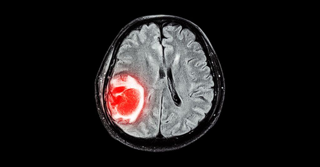 科學家開發奈米級機器人帶藥進大腦治療動脈瘤。