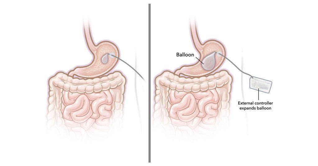 美國麻省理工學院最新推出一款突破性的新型胃內氣球（gastric balloon）。